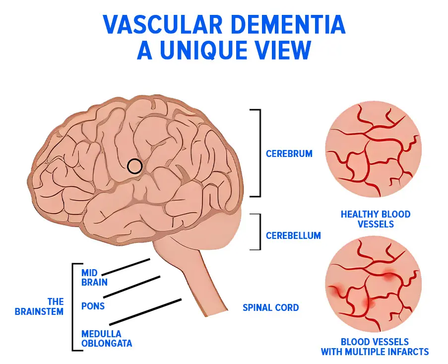 new treatment for vascular dementia